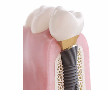 Choosing a Professional for Your Dental Implants in Lawrence, MA