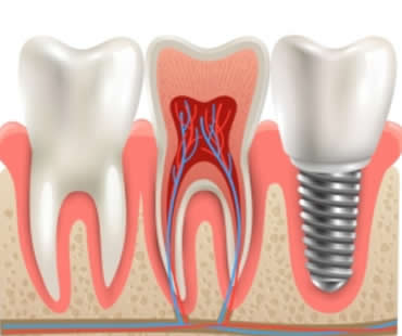 When to Choose Mini Dental Implants